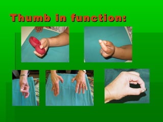 Hand Therapy - The Rule Of Thumb | PPT