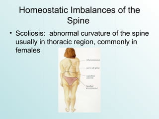 Homeostatic Imbalances of the Spine  Scoliosis:  abnormal curvature of the spine usually in thoracic region, commonly in females 
