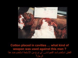 Cotton placed in cavities … what kind of weapon was used against this man ? القطن استُخدِم لسد الفجوات ...  أي نوع من الأسلحة استُخدِم ضد هذا الرجل؟ 