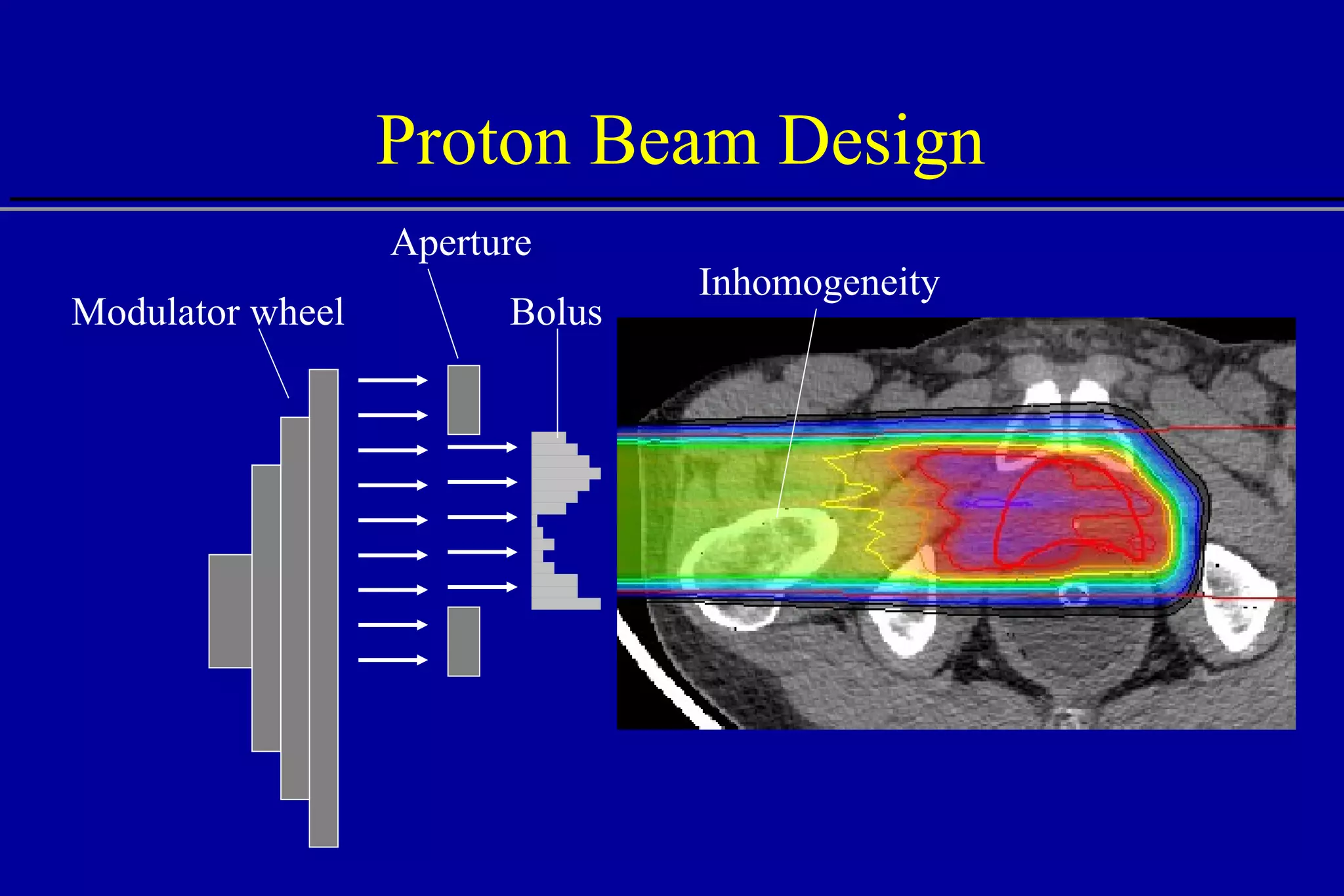 Proton Beam Design Modulator wheel Aperture Bolus Inhomogeneity 