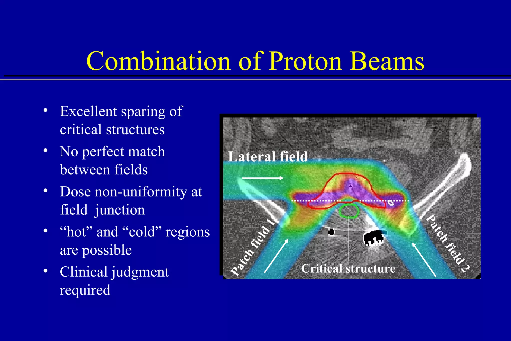 Combination of Proton Beams Excellent sparing of critical structures No perfect match between fields Dose non-uniformity at field  junction “ hot” and “cold” regions are possible Clinical judgment required Lateral field Patch field 2 Patch field 1 Critical structure 