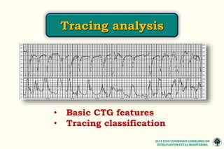 • Basic CTG features
• Tracing classification
Tracing analysis
2015 FIGO CONSENSUS GUIDELINES ON
INTRAPARTUM FETAL MONITORING
 