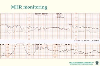 The 2015 FIGO consensus guidelines on intrapartum fetal monitoring ...