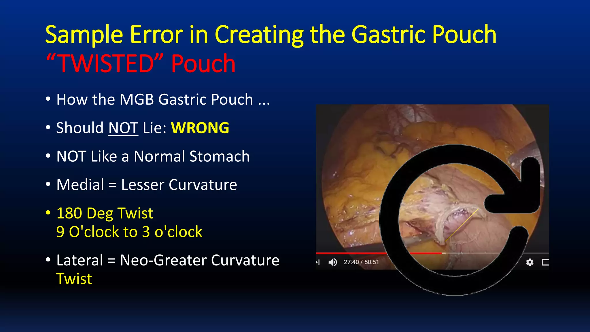 Sample Error in Creating the Gastric Pouch
“TWISTED” Pouch
• How the MGB Gastric Pouch ...
• Should NOT Lie: WRONG
• NOT Like a Normal Stomach
• Medial = Lesser Curvature
• 180 Deg Twist
9 O'clock to 3 o'clock
• Lateral = Neo-Greater Curvature
Twist
 