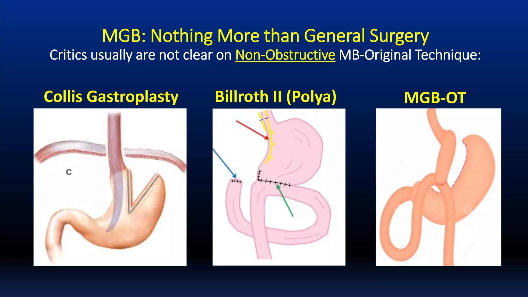 MGB: Nothing More than General Surgery
Critics usually are not clear on Non-Obstructive MB-Original Technique:
Collis Gastroplasty Billroth II (Polya) MGB-OT
 