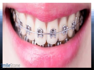 The 5 signs you may need braces
