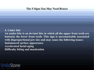 The 5 Signs You May Need Braces
4. Under bite
An under-bite is an deviant bite in which all the upper front teeth are
buttocks the lower front teeth. This sign is unremarkable associated
with disproportional jaw size and may cause the following issues:
Imbalanced surface appearance
Accelerated facial aging
Difficulty biting and mastication
 