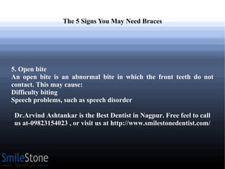 The 5 Signs You May Need Braces
5. Open bite
An open bite is an abnormal bite in which the front teeth do not
contact. This may cause:
Difficulty biting
Speech problems, such as speech disorder
Dr.Arvind Ashtankar is the Best Dentist in Nagpur. Free feel to call
us at-09823154023 , or visit us at http://www.smilestonedentist.com/
 