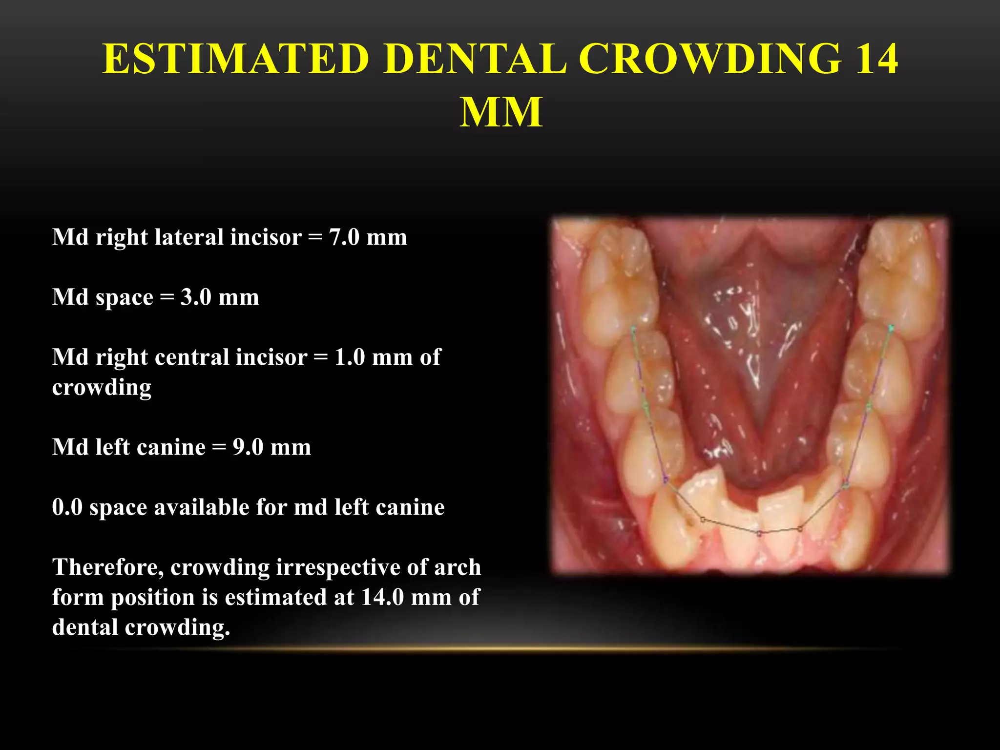 ESTIMATED DENTAL CROWDING 14
MM
Md right lateral incisor = 7.0 mm
Md space = 3.0 mm
Md right central incisor = 1.0 mm of
crowding
Md left canine = 9.0 mm
0.0 space available for md left canine
Therefore, crowding irrespective of arch
form position is estimated at 14.0 mm of
dental crowding.
 
