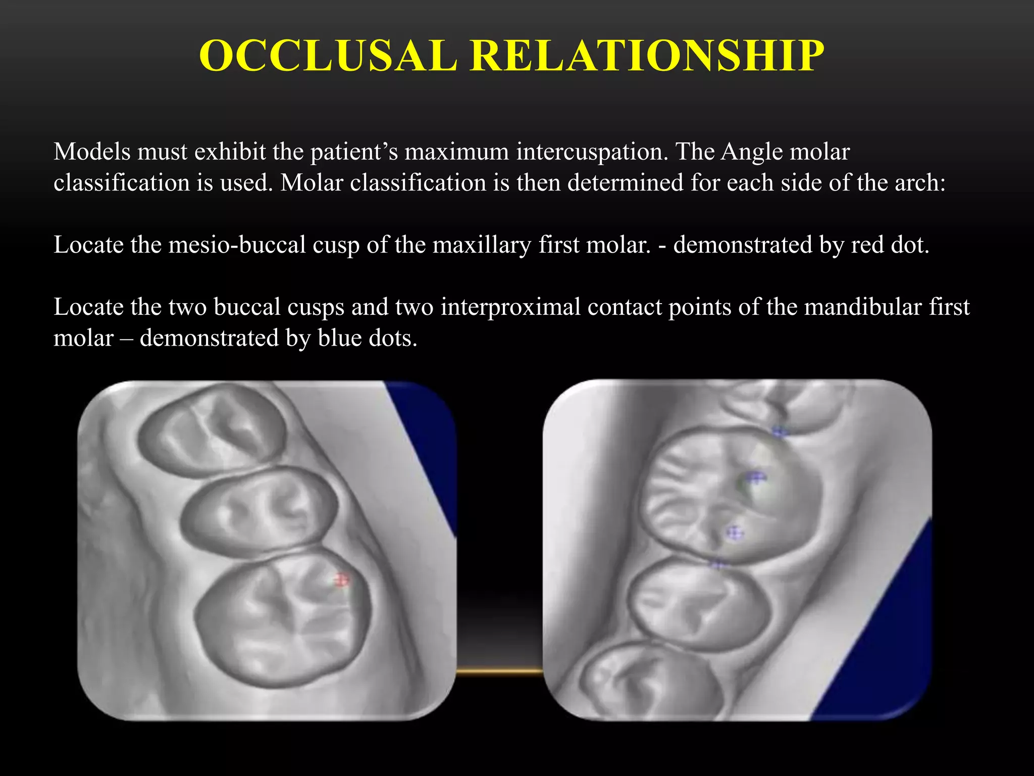 OCCLUSAL RELATIONSHIP
Models must exhibit the patient’s maximum intercuspation. The Angle molar
classification is used. Molar classification is then determined for each side of the arch:
Locate the mesio-buccal cusp of the maxillary first molar. - demonstrated by red dot.
Locate the two buccal cusps and two interproximal contact points of the mandibular first
molar – demonstrated by blue dots.
 