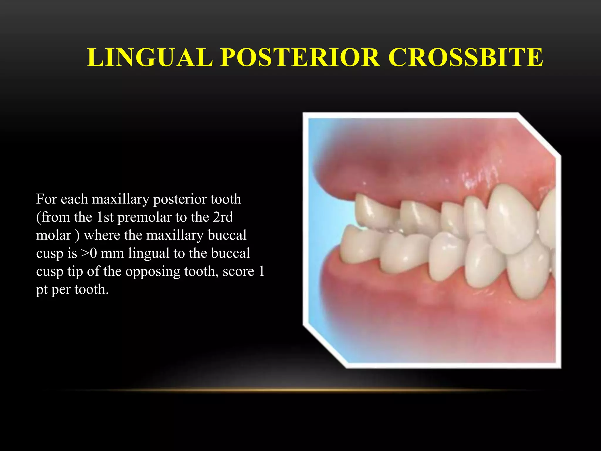 LINGUAL POSTERIOR CROSSBITE
For each maxillary posterior tooth
(from the 1st premolar to the 2rd
molar ) where the maxillary buccal
cusp is >0 mm lingual to the buccal
cusp tip of the opposing tooth, score 1
pt per tooth.
 