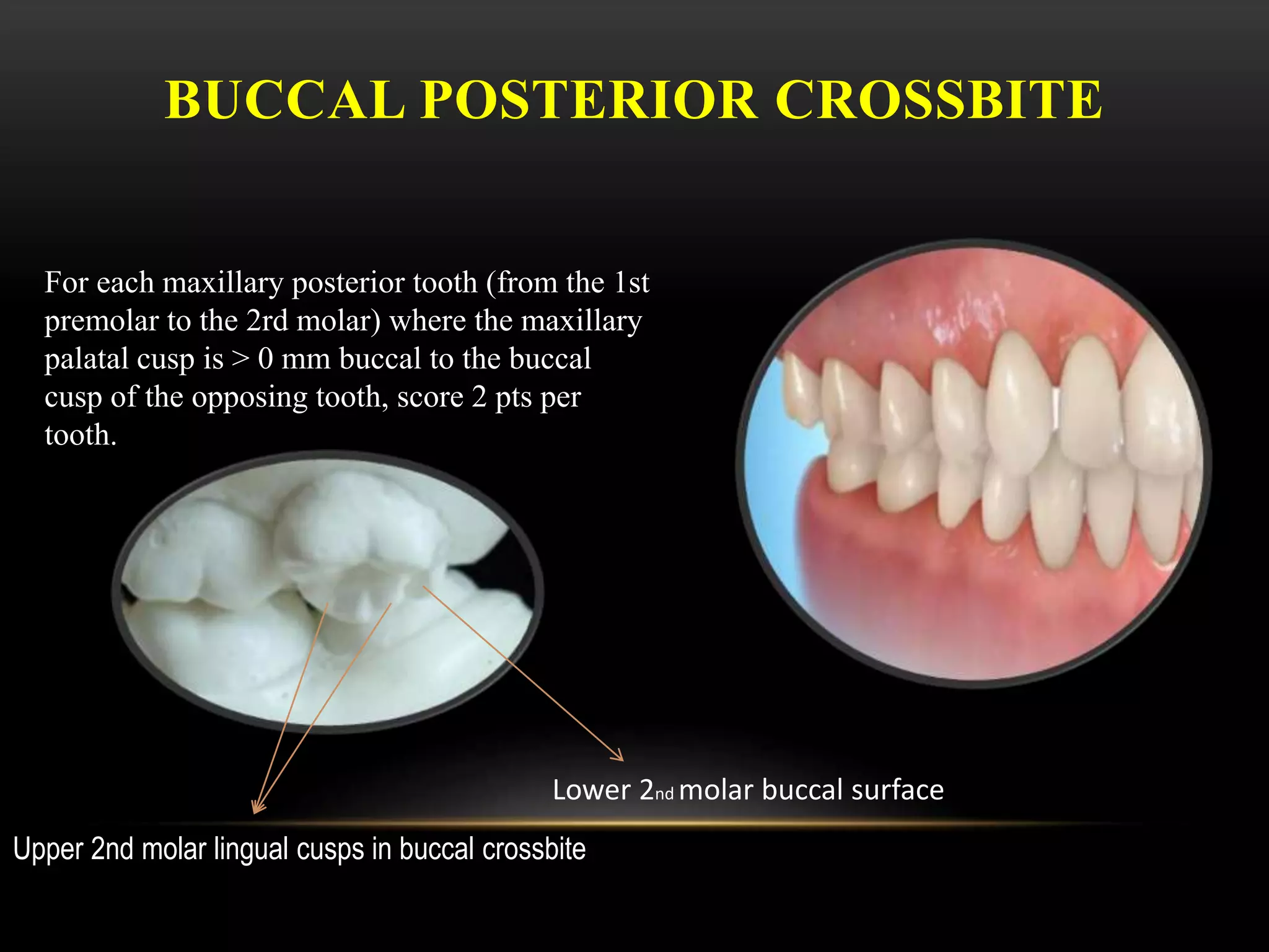 BUCCAL POSTERIOR CROSSBITE
For each maxillary posterior tooth (from the 1st
premolar to the 2rd molar) where the maxillary
palatal cusp is > 0 mm buccal to the buccal
cusp of the opposing tooth, score 2 pts per
tooth.
Lower 2nd molar buccal surface
Upper 2nd molar lingual cusps in buccal crossbite
 
