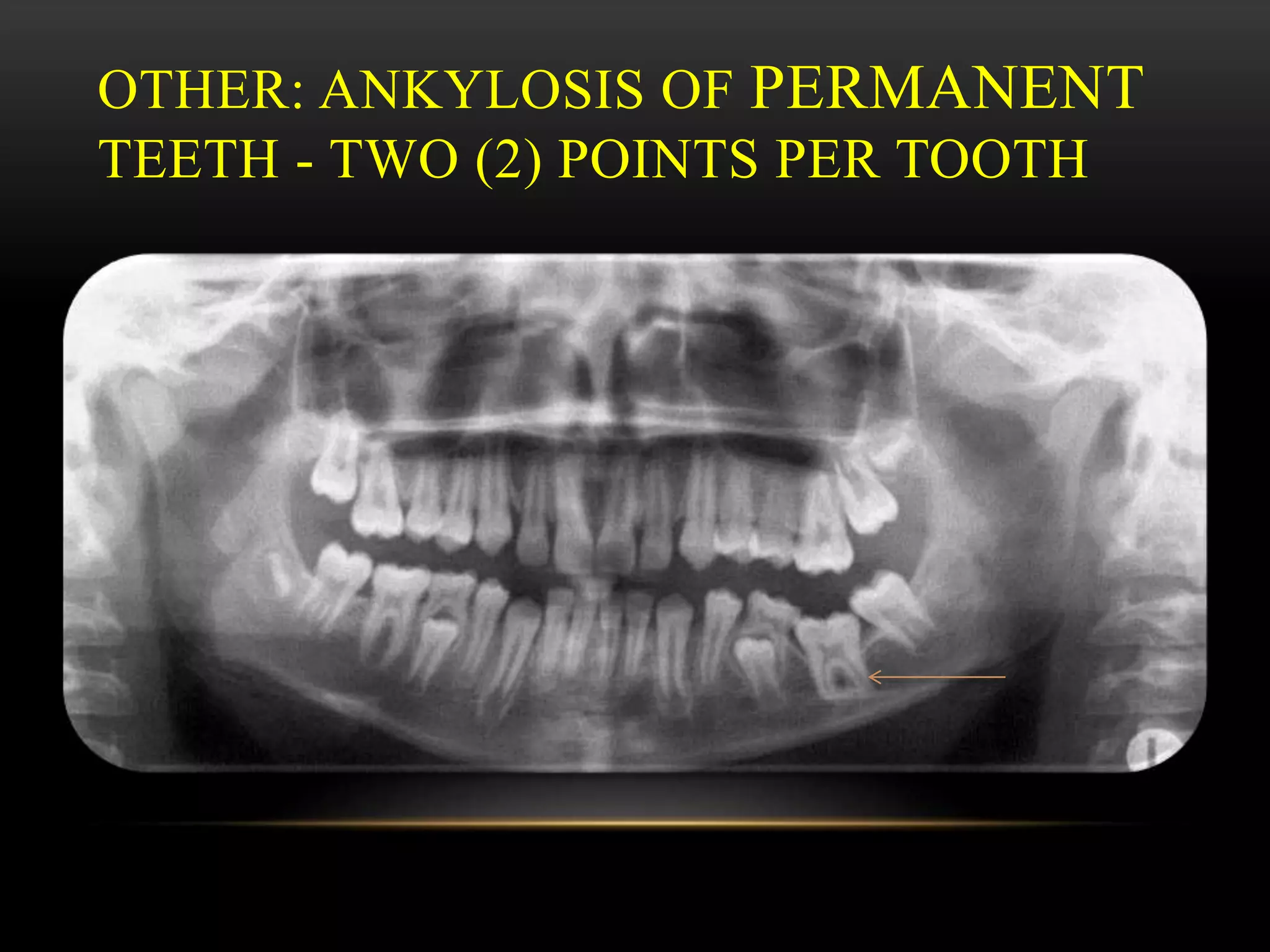 OTHER: ANKYLOSIS OF PERMANENT
TEETH - TWO (2) POINTS PER TOOTH
 