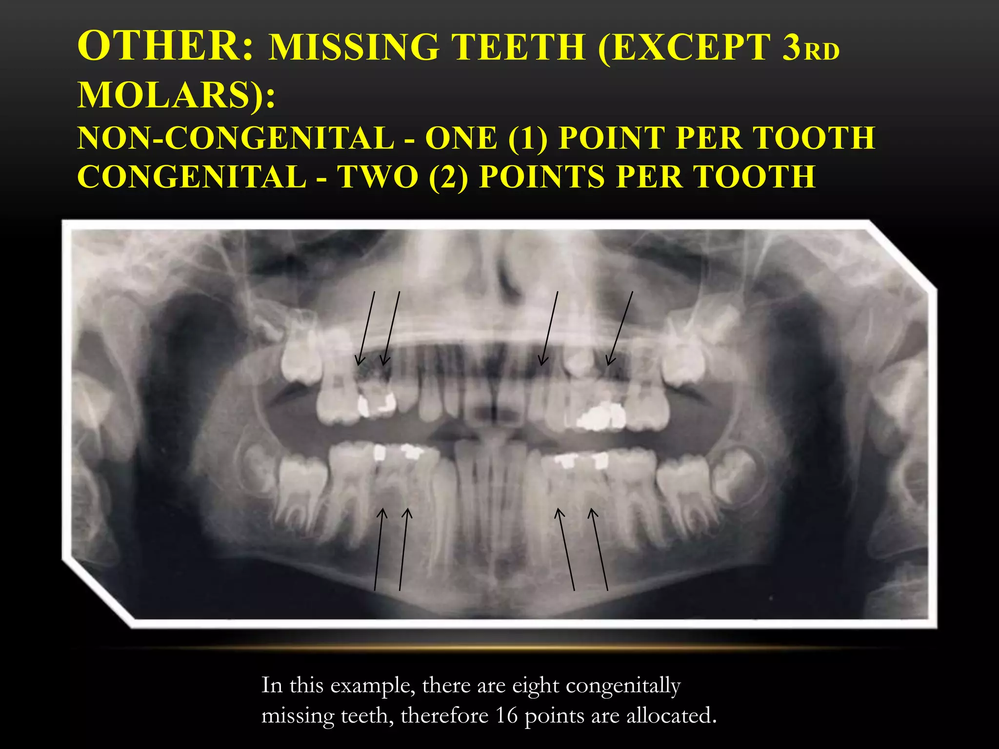 OTHER: MISSING TEETH (EXCEPT 3RD
MOLARS):
NON-CONGENITAL - ONE (1) POINT PER TOOTH
CONGENITAL - TWO (2) POINTS PER TOOTH
In this example, there are eight congenitally
missing teeth, therefore 16 points are allocated.
 