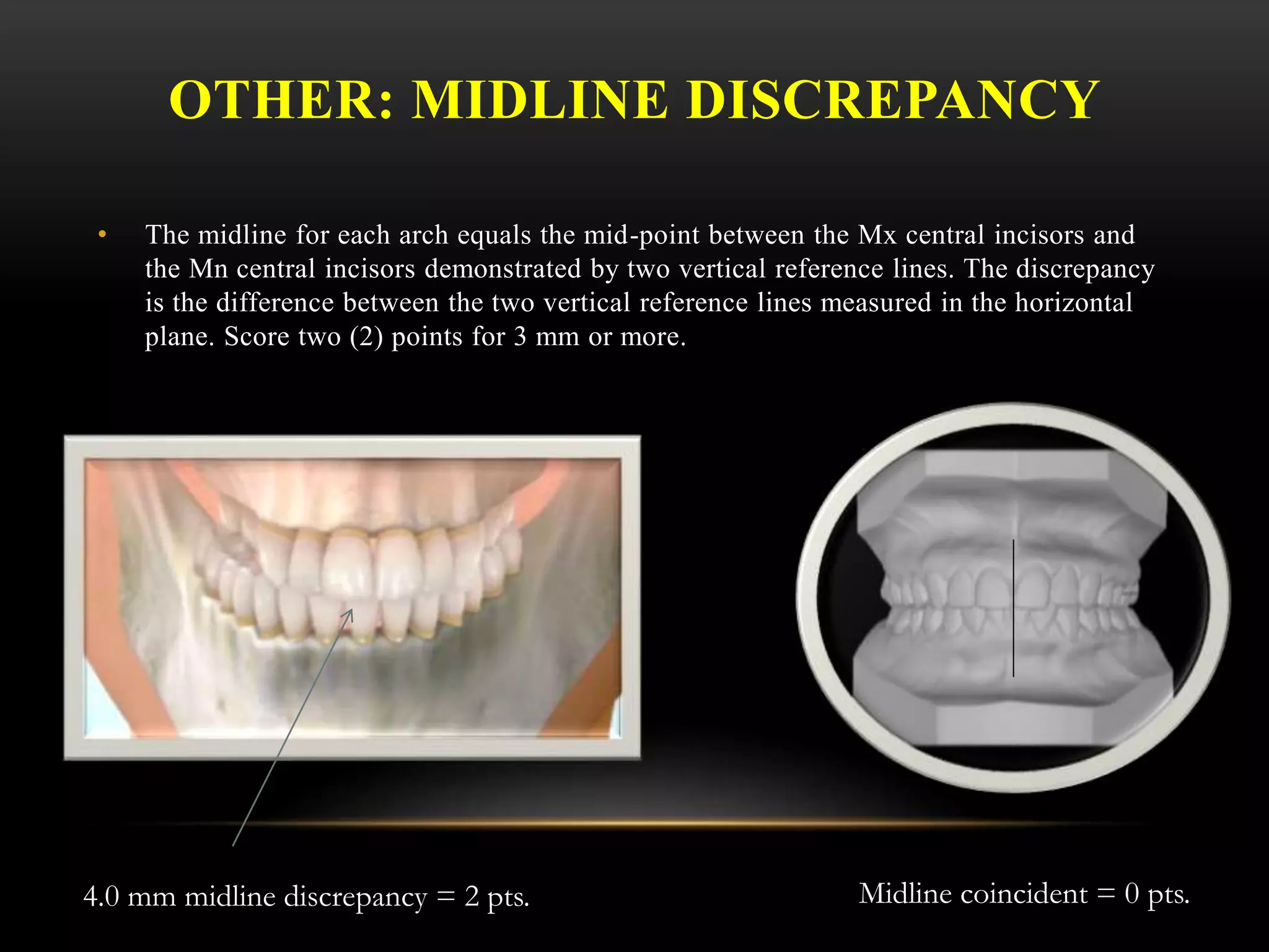 OTHER: MIDLINE DISCREPANCY
• The midline for each arch equals the mid-point between the Mx central incisors and
the Mn central incisors demonstrated by two vertical reference lines. The discrepancy
is the difference between the two vertical reference lines measured in the horizontal
plane. Score two (2) points for 3 mm or more.
4.0 mm midline discrepancy = 2 pts. Midline coincident = 0 pts.
 