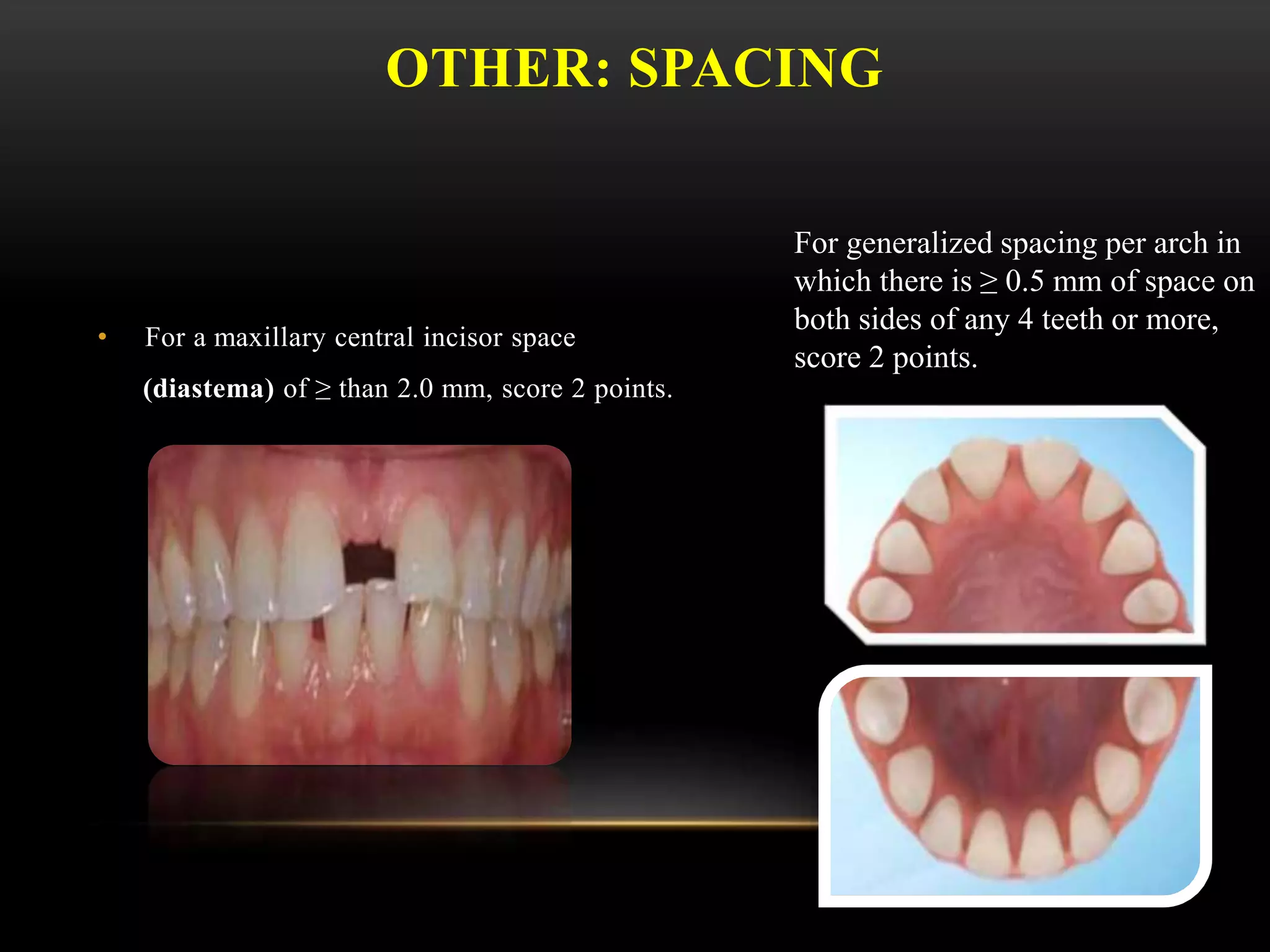OTHER: SPACING
• For a maxillary central incisor space
(diastema) of ≥ than 2.0 mm, score 2 points.
For generalized spacing per arch in
which there is ≥ 0.5 mm of space on
both sides of any 4 teeth or more,
score 2 points.
 