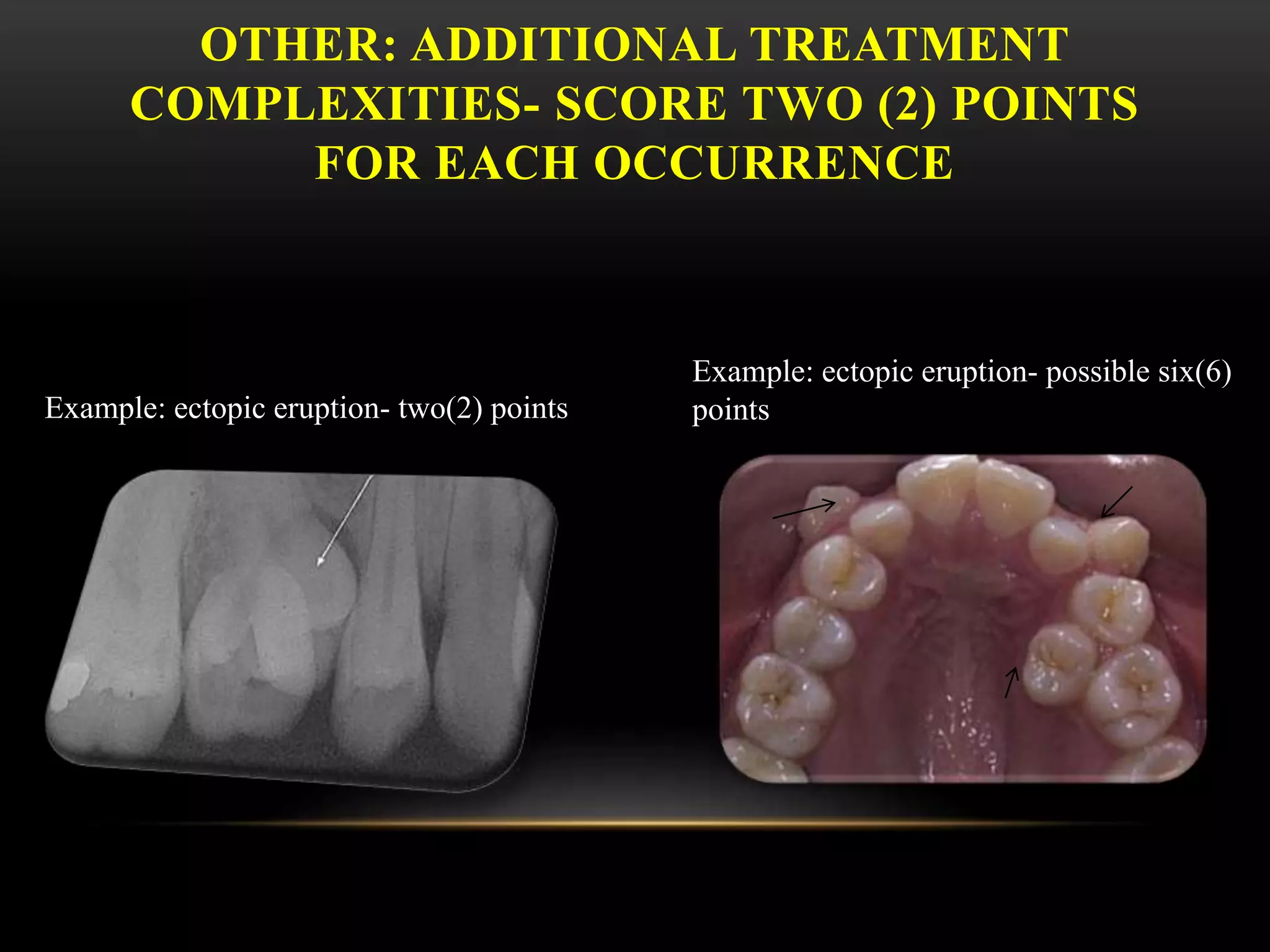 OTHER: ADDITIONAL TREATMENT
COMPLEXITIES- SCORE TWO (2) POINTS
FOR EACH OCCURRENCE
Example: ectopic eruption- two(2) points
Example: ectopic eruption- possible six(6)
points
 