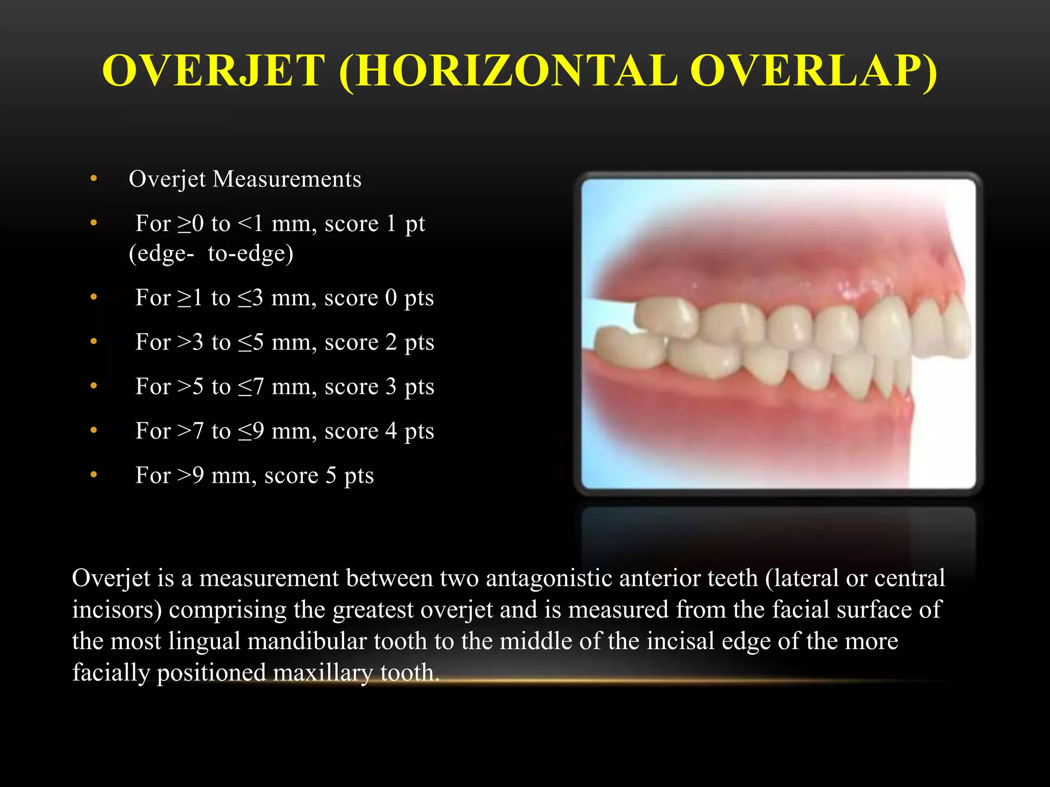 OVERJET (HORIZONTAL OVERLAP)
• Overjet Measurements
• For ≥0 to <1 mm, score 1 pt
(edge- to-edge)
• For ≥1 to ≤3 mm, score 0 pts
• For >3 to ≤5 mm, score 2 pts
• For >5 to ≤7 mm, score 3 pts
• For >7 to ≤9 mm, score 4 pts
• For >9 mm, score 5 pts
Overjet is a measurement between two antagonistic anterior teeth (lateral or central
incisors) comprising the greatest overjet and is measured from the facial surface of
the most lingual mandibular tooth to the middle of the incisal edge of the more
facially positioned maxillary tooth.
 