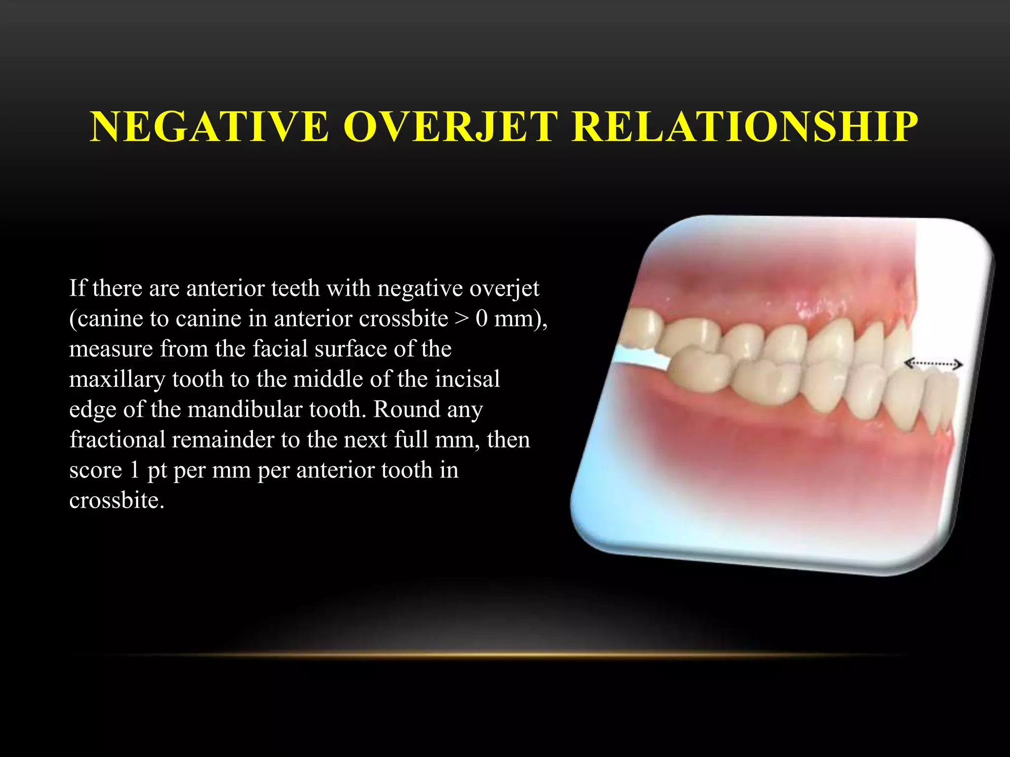 NEGATIVE OVERJET RELATIONSHIP
If there are anterior teeth with negative overjet
(canine to canine in anterior crossbite > 0 mm),
measure from the facial surface of the
maxillary tooth to the middle of the incisal
edge of the mandibular tooth. Round any
fractional remainder to the next full mm, then
score 1 pt per mm per anterior tooth in
crossbite.
 