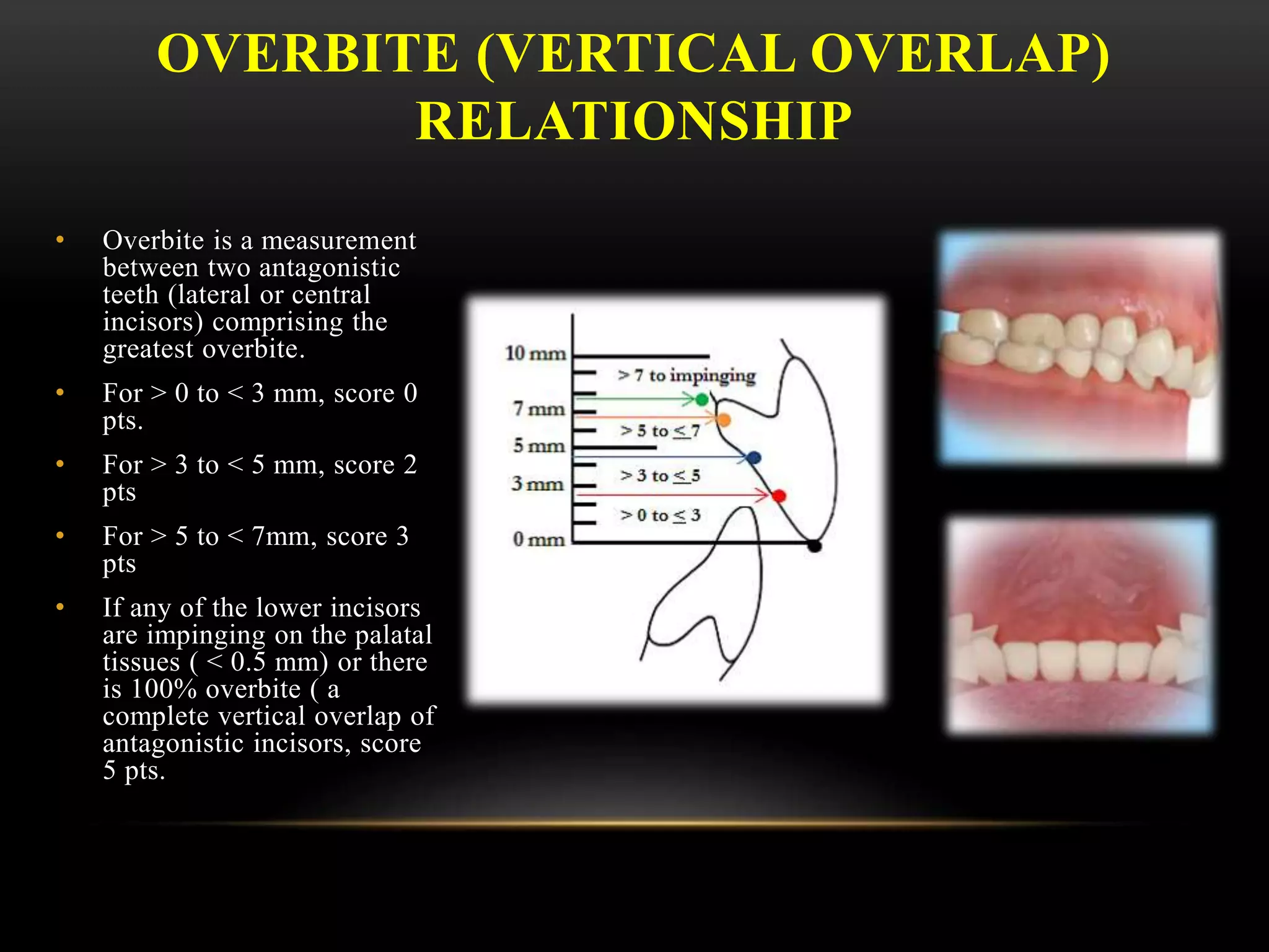 OVERBITE (VERTICAL OVERLAP)
RELATIONSHIP
• Overbite is a measurement
between two antagonistic
teeth (lateral or central
incisors) comprising the
greatest overbite.
• For > 0 to < 3 mm, score 0
pts.
• For > 3 to < 5 mm, score 2
pts
• For > 5 to < 7mm, score 3
pts
• If any of the lower incisors
are impinging on the palatal
tissues ( < 0.5 mm) or there
is 100% overbite ( a
complete vertical overlap of
antagonistic incisors, score
5 pts.
 