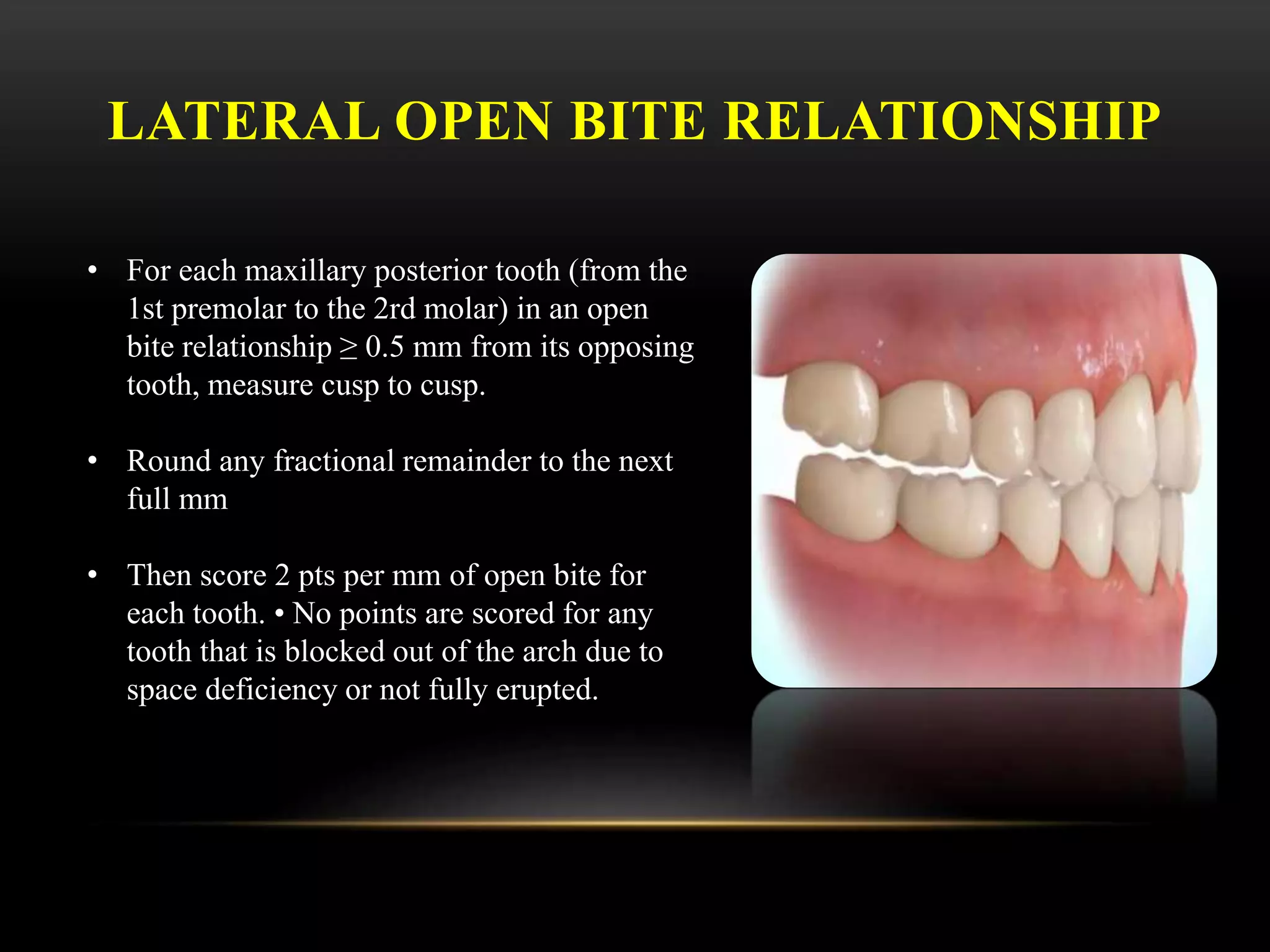 LATERAL OPEN BITE RELATIONSHIP
• For each maxillary posterior tooth (from the
1st premolar to the 2rd molar) in an open
bite relationship ≥ 0.5 mm from its opposing
tooth, measure cusp to cusp.
• Round any fractional remainder to the next
full mm
• Then score 2 pts per mm of open bite for
each tooth. • No points are scored for any
tooth that is blocked out of the arch due to
space deficiency or not fully erupted.
 