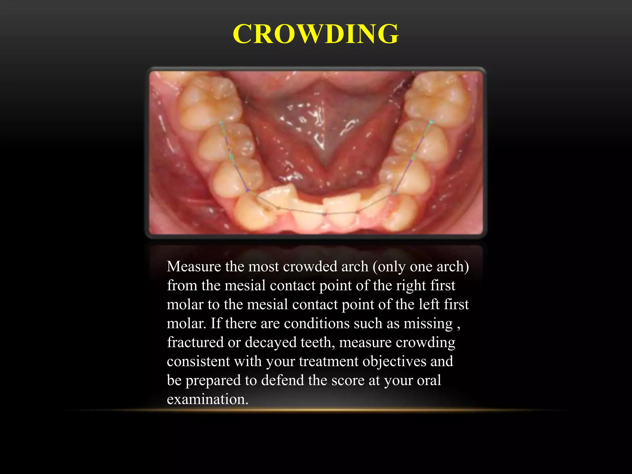 CROWDING
Measure the most crowded arch (only one arch)
from the mesial contact point of the right first
molar to the mesial contact point of the left first
molar. If there are conditions such as missing ,
fractured or decayed teeth, measure crowding
consistent with your treatment objectives and
be prepared to defend the score at your oral
examination.
 