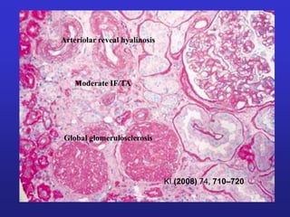 KI (2008) 74, 710–720 
Arteriolar reveal hyalinosis 
Moderate IF/TA 
Global glomerulosclerosis 
 