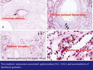 Arteriohyalinosis. 
Brenner and Rector's The Kidney, 9th ed. 
Fibrous intimal thickening 
Tubular atrophy. 
Lipofuscin pigment 
Two markers: senescence-associated -galactosidase (SA– GAL) and accumulation of 
lipofuscin granules. 
 