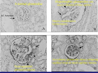 A normal glomerulus 
Af. Arteriole. 
Hypertrophic glomerulus with 
massive dilatation of hilar capillary 
Massive nonobstructive 
hyaline deposit 
Focal segmental 
glomerulosclerosis 
An ischemic glomerulus shows collapsing 
capillary loops & small capillary lumens. 
 
