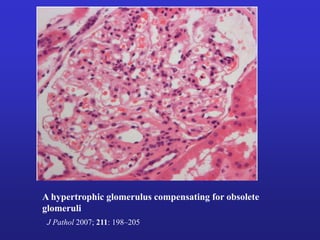 A hypertrophic glomerulus compensating for obsolete 
glomeruli 
J Pathol 2007; 211: 198–205 
 