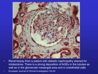 • Renal biopsy from a patient with diabetic nephropathy stained for 
imidazolone. There is a strong deposition of AGEs in the tubules as 
well as in the glomerular mesangial area and in endothelial cells 
• European Journal of Clinical Investigation Vol 40 
 