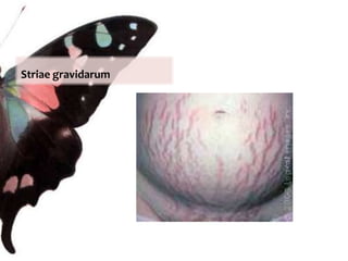 Structures include the mons pubis, labia majora, labia minora, prepuce, frenulum, fourchette, clitoris and vestibulee. OvariesPhotograph of the vulva. 1. Pubic hair (shaved), 2.Clitoral hood, 3. Clitoris, 4. Labia majora, 5. Labia minora (enclosing the Vaginal Opening), 6. Perineum.