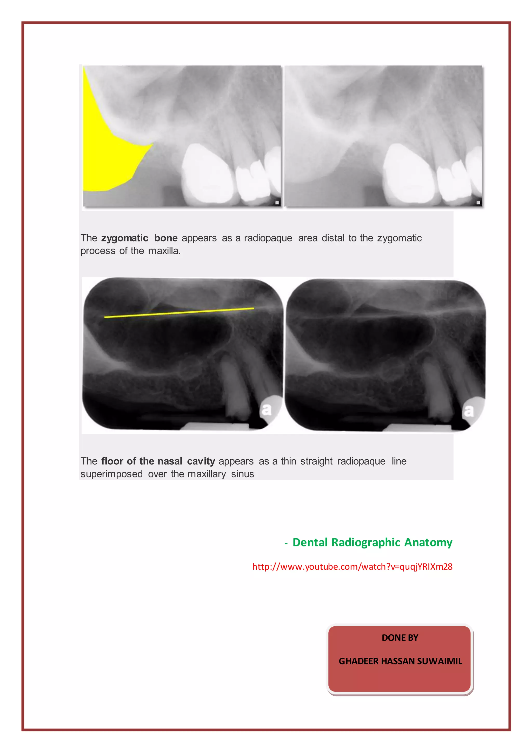 The anterior portion of intraoral radiographs | DOCX