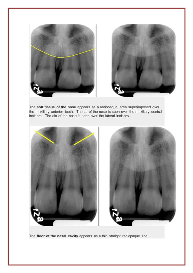 The anterior portion of intraoral radiographs