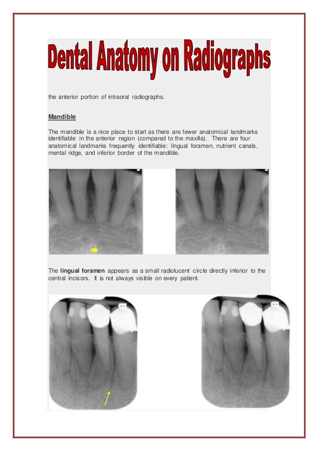 The anterior portion of intraoral radiographs