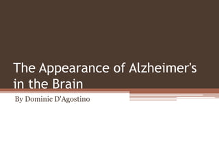 The Appearance of Alzheimer's
in the Brain
By Dominic D'Agostino
 