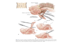 The appendix, appendicitis and it's management | PPTX
