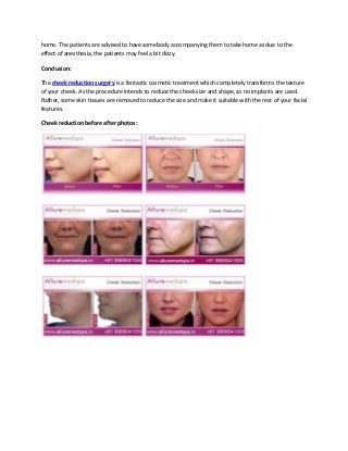 home. The patients are advised to have somebody accompanying them to take home as due to the
effect of anesthesia, the patients may feel a bit dizzy.
Conclusion:
The cheek reduction surgery is a fantastic cosmetic treatment which completely transforms the texture
of your cheek. As the procedure intends to reduce the cheek size and shape, so no implants are used.
Rather, some skin tissues are removed to reduce the size and make it suitable with the rest of your facial
features.
Cheek reduction before after photos:
 