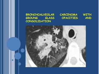The basic interpretation of hrct | PPT