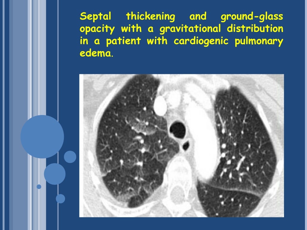 The basic interpretation of hrct