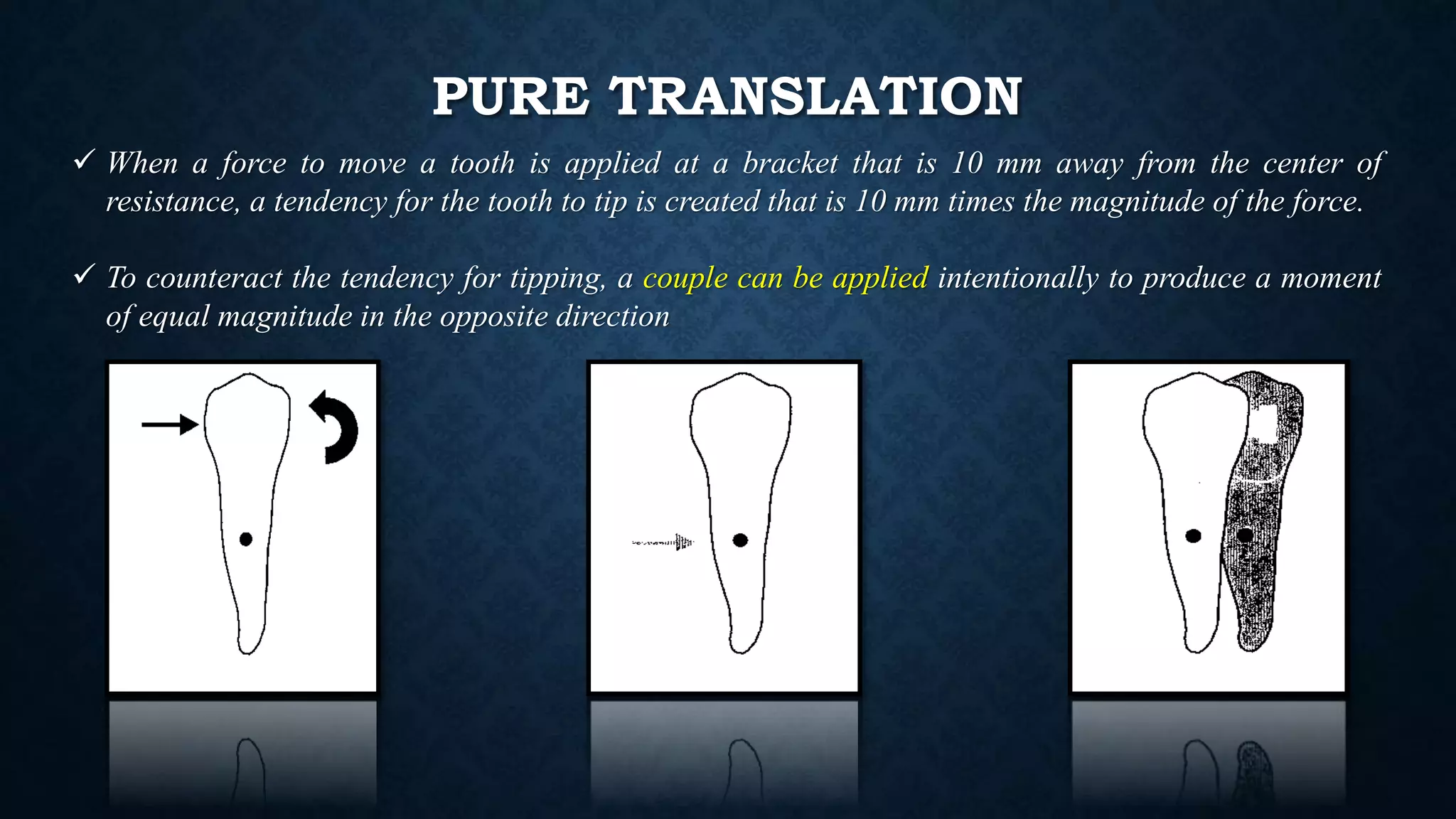 The basics of Orthodontic Mechanics | PPTX