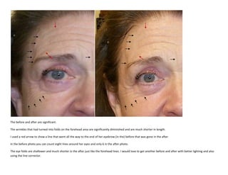 The before and after are significant.<br />The wrinkles that had turned into folds on the forehead area are significantly diminished and are much shorter in length.<br />I used a red arrow to show a line that went all the way to the end of her eyebrow (in the) before that was gone in the after.<br />In the before photo you can count eight lines around her eyes and only 6 in the after photo.<br />The eye folds are shallower and much shorter in the after just like the forehead lines. I would love to get another before and after with better lighting and also using the line corrector.<br />
