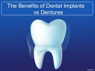 The Benefits of Dental Implants
vs Dentures
 