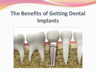 The Benefits of Getting Dental
Implants
 