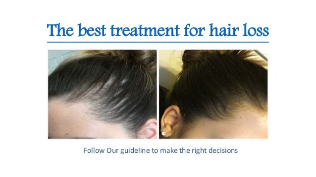 The Best Treatment For Hair Loss
