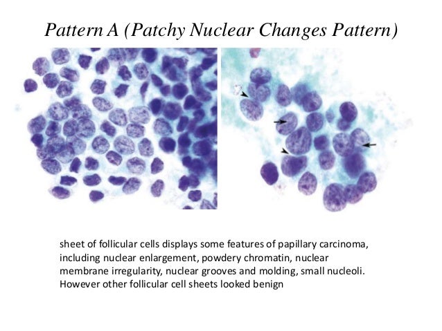 The Bethesda System For Reporting Thyroid Cytopathology