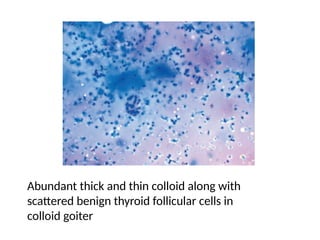 The Bethesda System for Reporting Thyroid Cytopathology.pptx