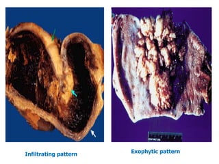 Infiltrating pattern Exophytic pattern
 