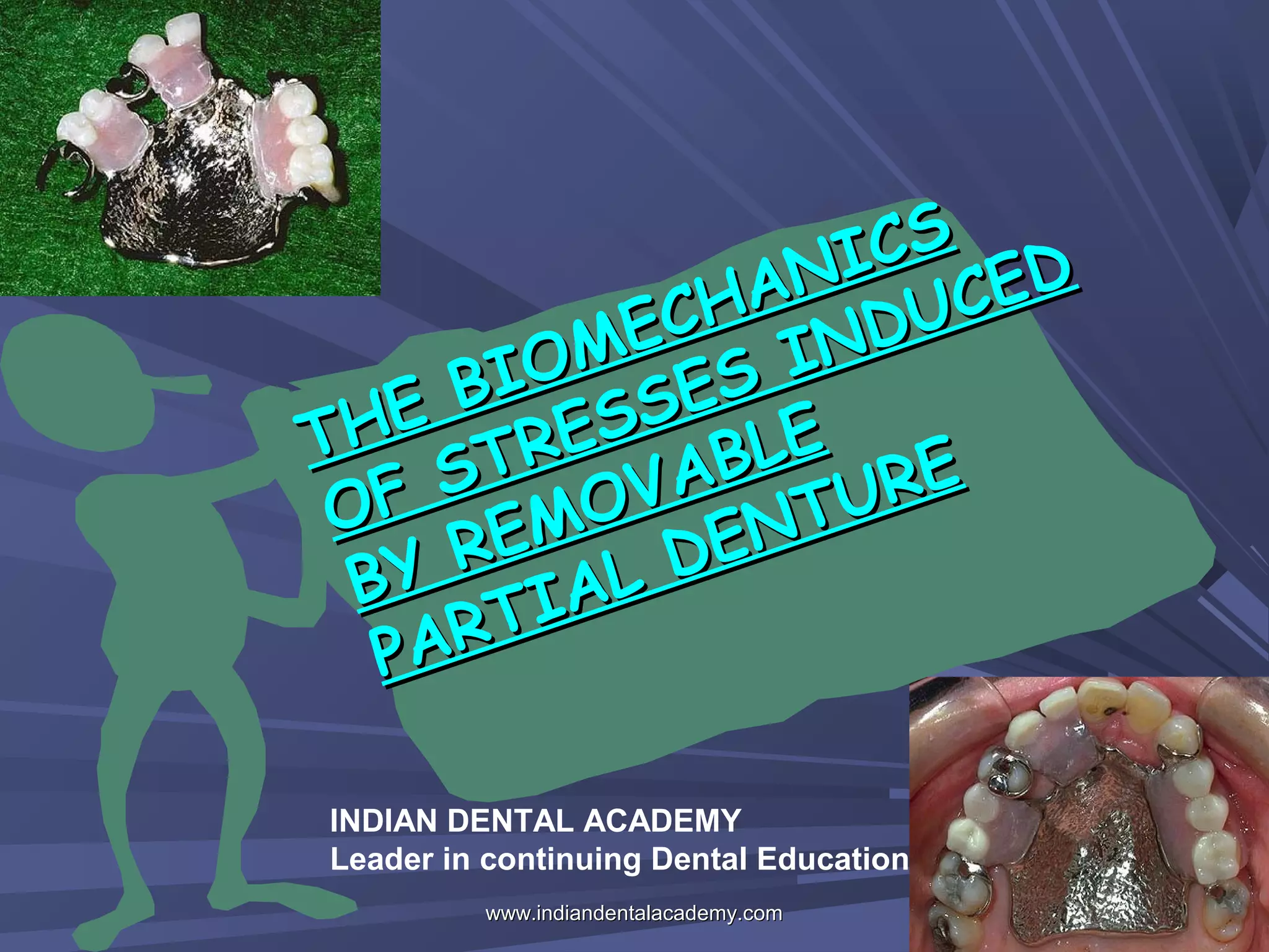 The biomechanics of stresses induced by removable partial denture PPT
