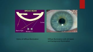 Optics of diffuse illumination Diffuse illumination with slit beam
and background illumination
 